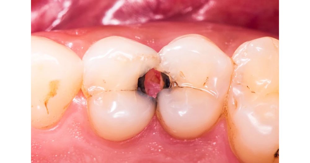 Лечение кариеса под микроскопом в Одессе: точность и безопасность